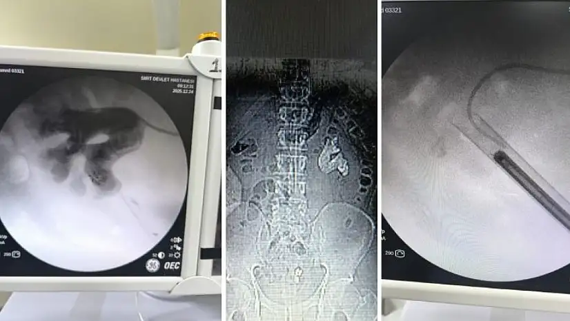 Siirt'te Nadir Görülen Geyik Boynuzu Taşı Tek Ameliyatta Temizlendi! Vatandaşın Böbreğini Tamamen Kaplamıştı