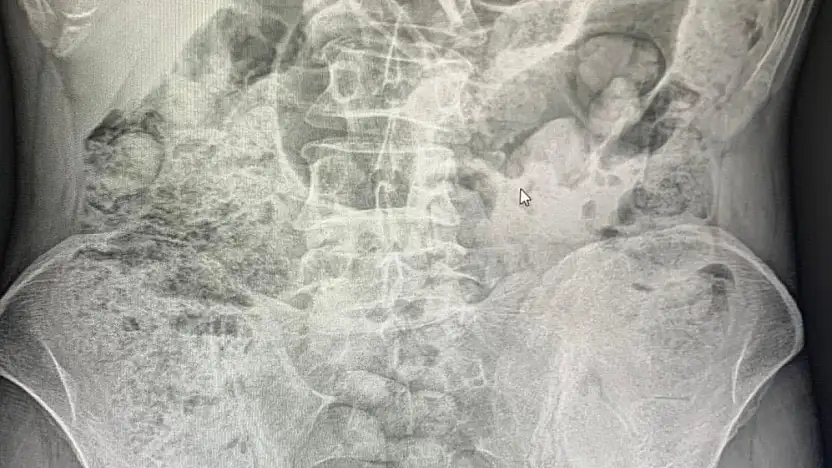 Siirt'te Emniyetten Filmleri Aratmayan Operasyon: Midelerinden 119 Paket Uyuşturucu Çıkarıldı! Ameliyattan Sonra 4 Kişi Tutuklandı