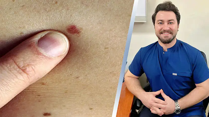 Siirt'te Sıkça Görülen Deri Kanseri Uyarısı: Uzm. Dr. Aslankoç'tan Önemli Uyarılar