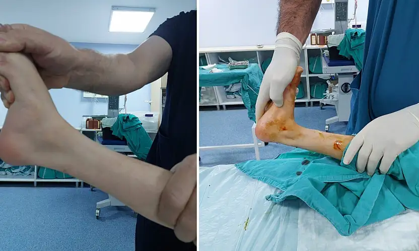 Özel Siirt Hayat Hastanesinde Bir İlk: Parmak Ucu Yürüme Ameliyatı Başarıyla Gerçekleştirildi