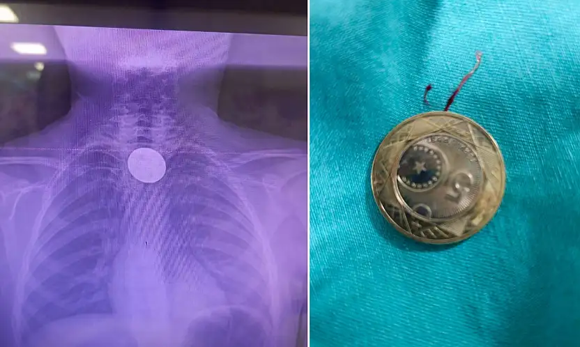 Siirt'te boğazına madeni para kaçan çocuk, başarılı operasyonla kurtarıldı