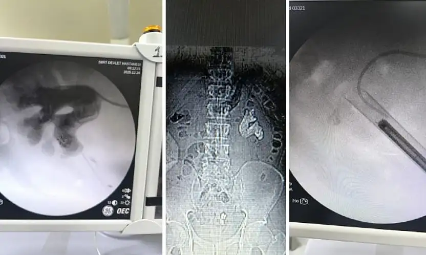 Siirt'te Nadir Görülen Geyik Boynuzu Taşı Tek Ameliyatta Temizlendi! Vatandaşın Böbreğini Tamamen Kaplamıştı