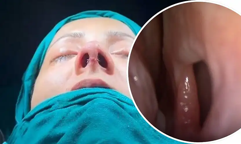 Siirt'te Septal Perforasyon Onarımı ve Revizyon Rinoplasti Ameliyatı Başarıyla Yapıldı