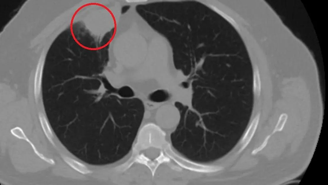 Dünya tıp literatüründe bir ilk: Covid-19, akciğer kanserini taklit etti