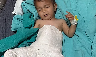 Siirt'te 15 Aylık Bebek, Başarılı Kalça Çıkığı Ameliyatıyla Sağlığına Kavuştu