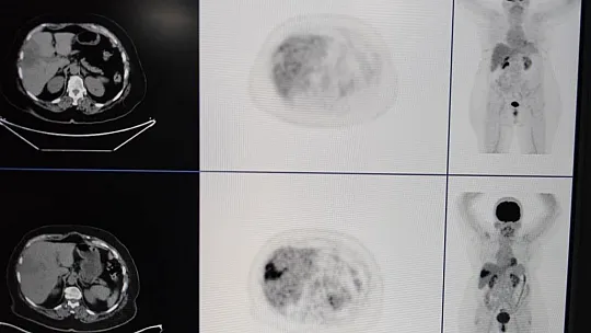 Diyarbakır'da kanser tedavilerinde kullanılan TARE işlemiyle hastalar şifa buluyor