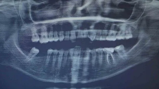 Uzmanı implant tedavisi sonrası yapılması gerekenleri anlattı