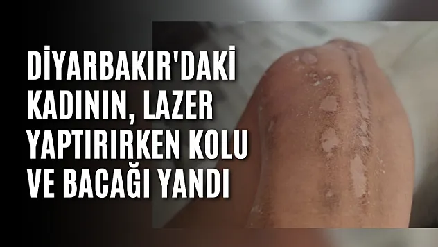 Diyarbakır'daki kadının, lazer yaptırırken kolu ve bacağı yandı